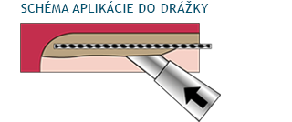 Vlepenie dodatočnej helikálnej výstuže do drážky v murive alebo betónu